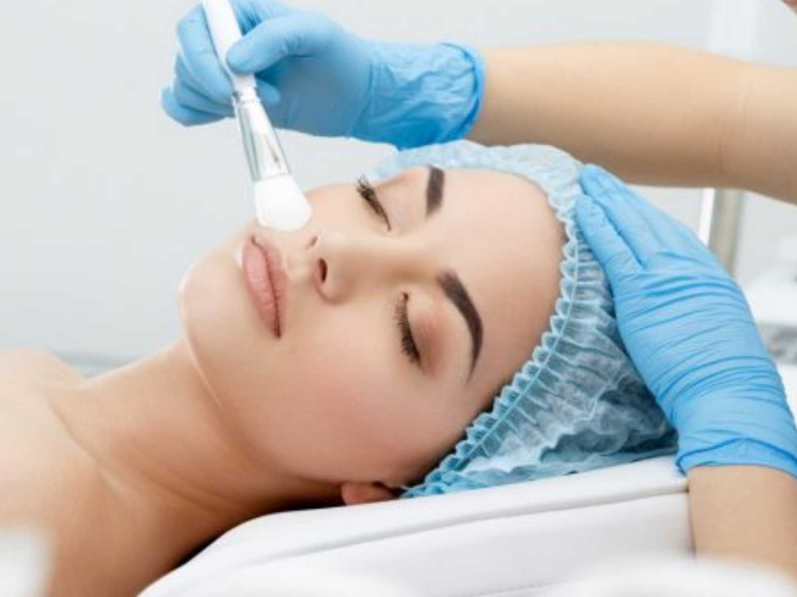 Химический пилинг